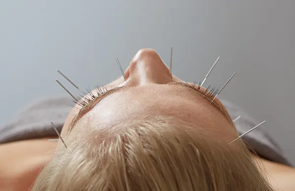 Zdjęcie Akupunktura: jak działa, na co pomaga i czy jest bezpieczna?