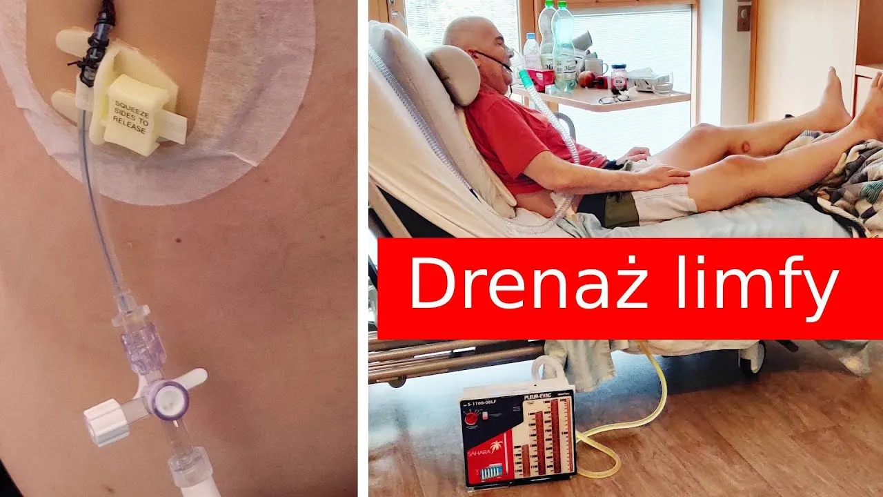 Zdjęcie Jakie leki chemioterapeutyczne są najskuteczniejsze w raku płuc?