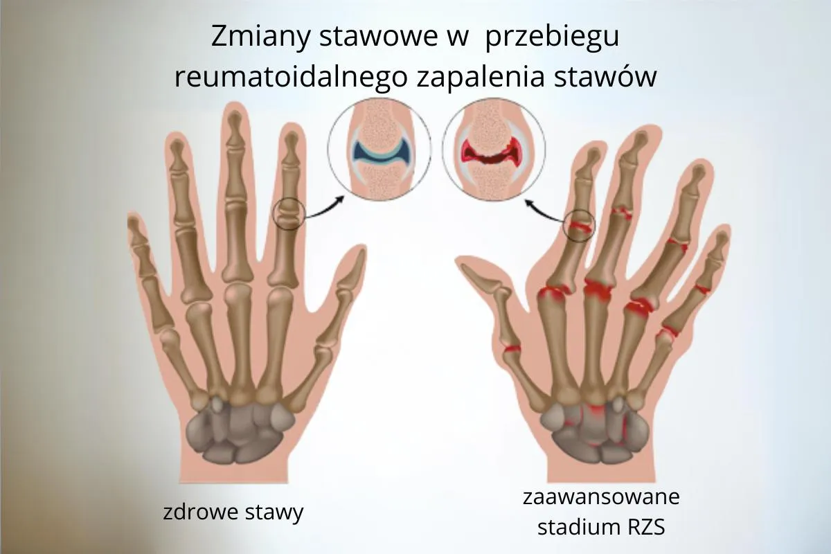 Zdjęcie Wszystkie objawy rzs - poznaj pierwsze oznaki tej poważnej choroby