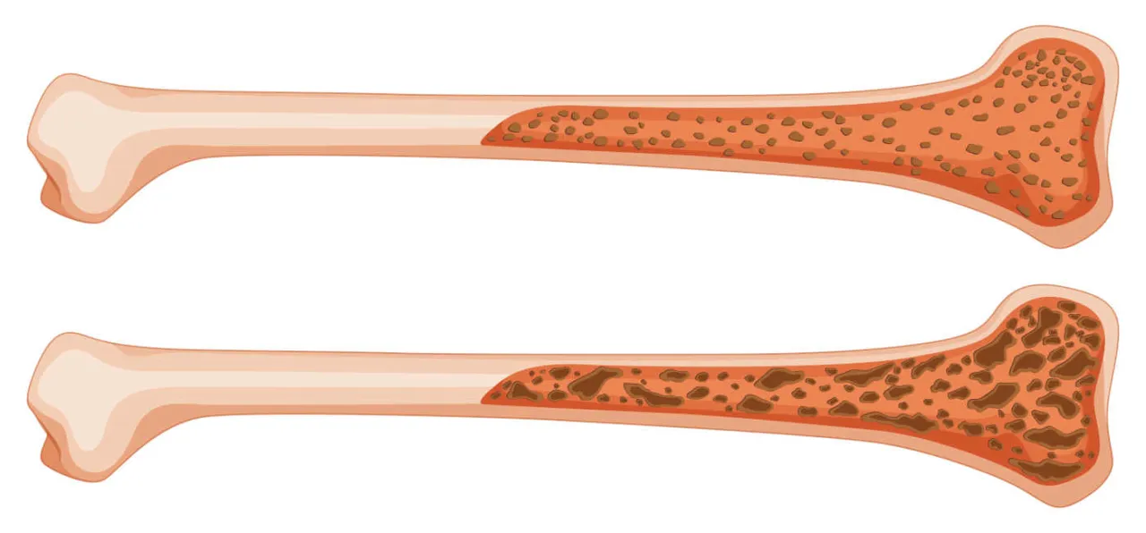 Zdjęcie Osteoporoza jakie badania krwi są kluczowe dla diagnozy i zdrowia?