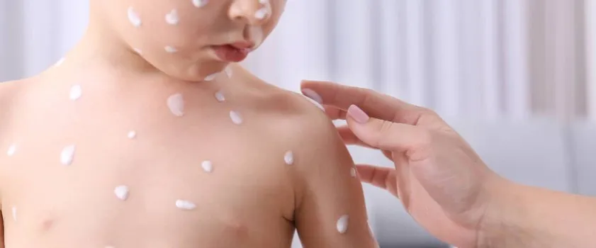 Zdjęcie Ospa jak postępować: skuteczne metody łagodzenia objawów i opieki