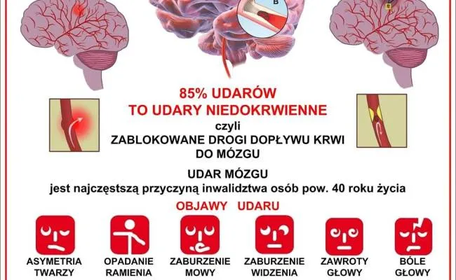 Zdjęcie Objawy udaru móżdżku i skuteczne metody leczenia – co musisz wiedzieć
