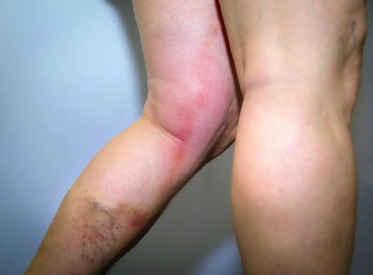 Zdjęcie Skutki uboczne po wenflonie – poznaj poważne komplikacje i objawy