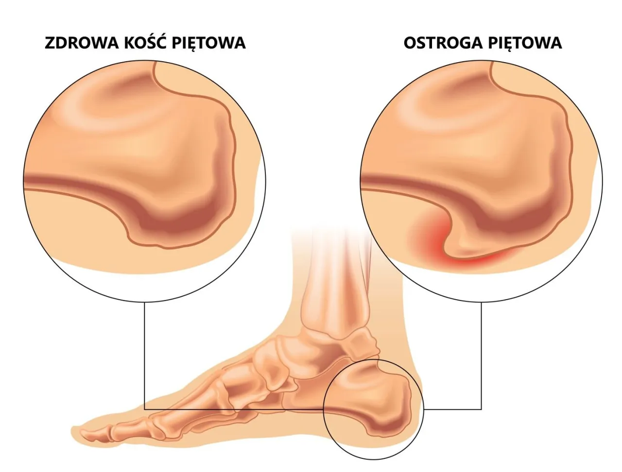 Zdjęcie Ile L4 na ostrogę piętową? Odpowiedź zależy od kluczowych czynnik&oacute;w