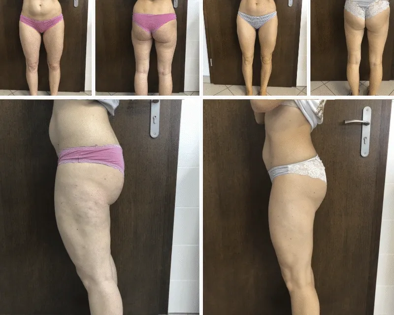 Zdjęcie Endermologia czy liposukcja - która metoda naprawdę działa lepiej?