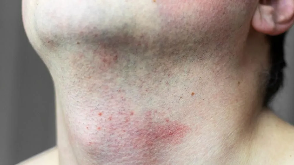 Zdjęcie Skuteczne sposoby na złagodzenie podrażnień po depilacji