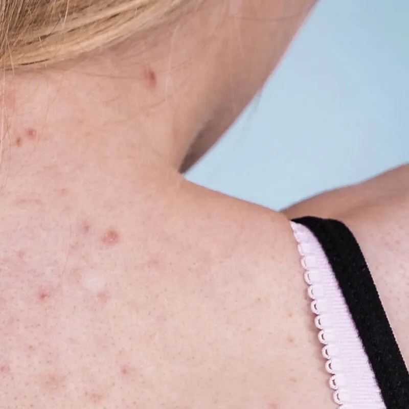 Zdjęcie Co na rozdrapane pryszcze: skuteczne metody leczenia i pielęgnacji