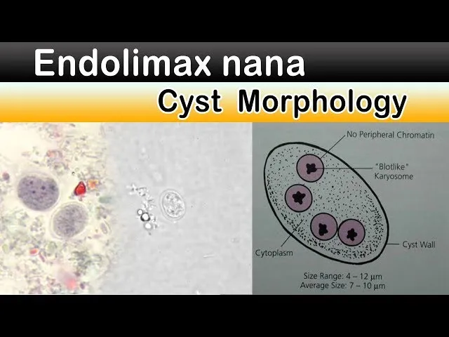 Zdjęcie Endolimax nana: 5 objawów infekcji i metody skutecznego leczenia