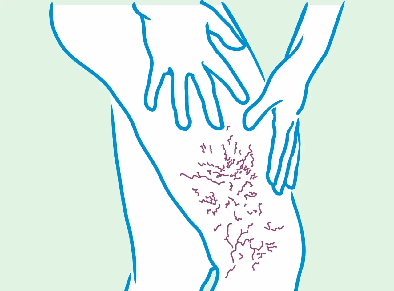 Zdjęcie Jakie leki na zakrzepicę nóg pomogą uniknąć powikłań?