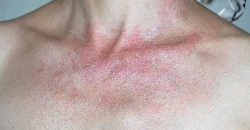 Zdjęcie Alergia na słońce: objawy, przyczyny i jak sobie z nią radzić?