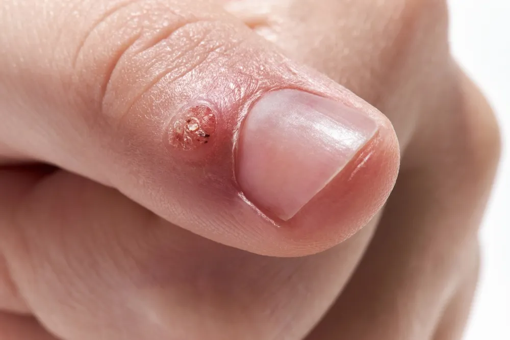 Zdjęcie Wirus HPV: objawy i zdjęcia – jak rozpoznać kłykciny i brodawki?