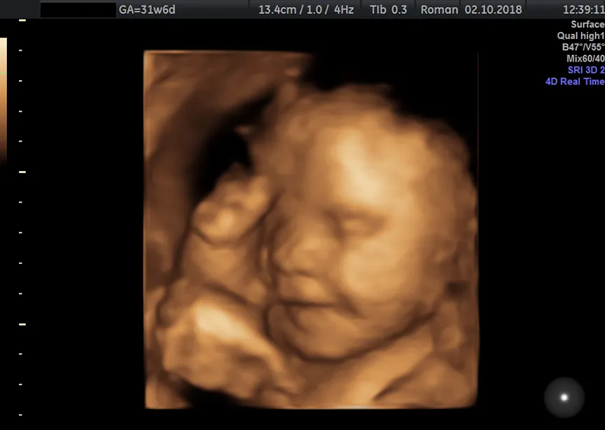 Zdjęcie Czy 3 badanie prenatalne jest refundowane przez NFZ? Sprawdź, co musisz wiedzieć