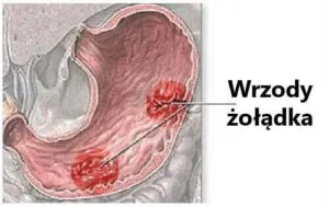Zdjęcie Wrzody czy nerwica żołądka objawy - jak je odróżnić i leczyć?