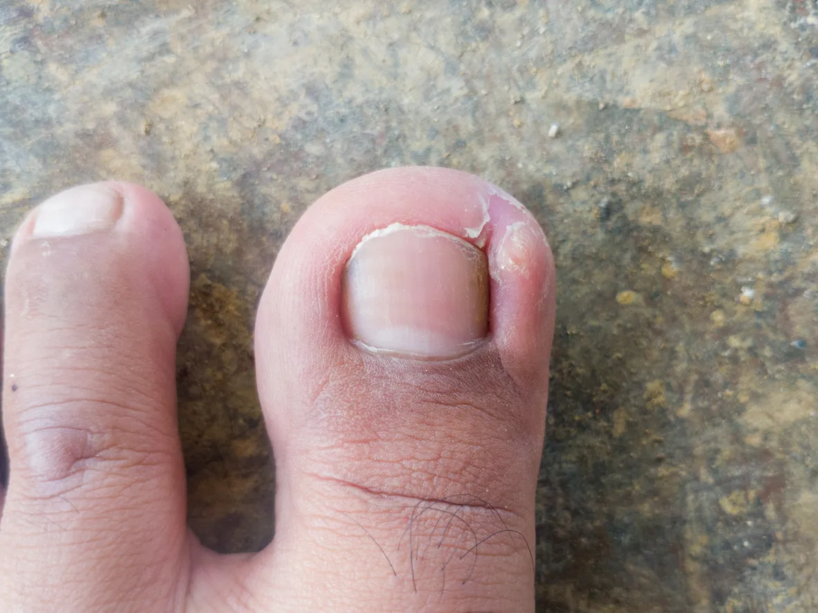 Zdjęcie Wrastający paznokieć: Jak usunąć? Domowe i profesjonalne metody