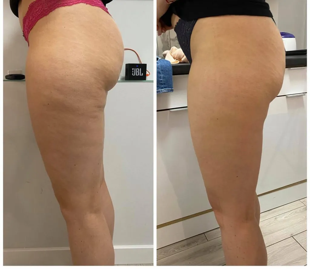 Zdjęcie Co daje endermologia? Efekty, które mogą Cię zaskoczyć