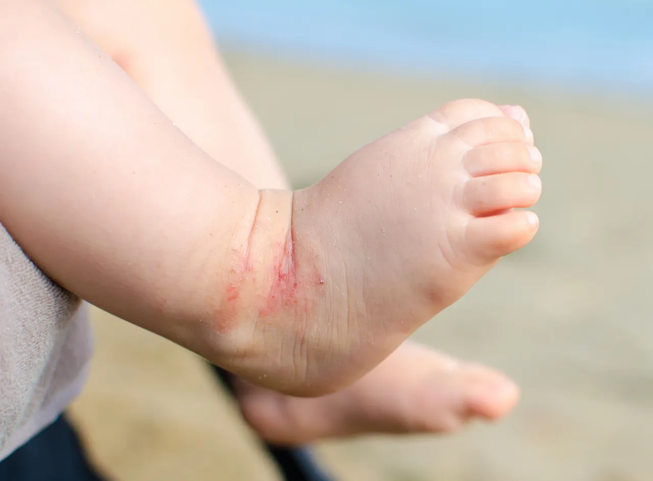 Zdjęcie Co na liszaj u dziecka - poznaj skuteczne metody leczenia i objawy