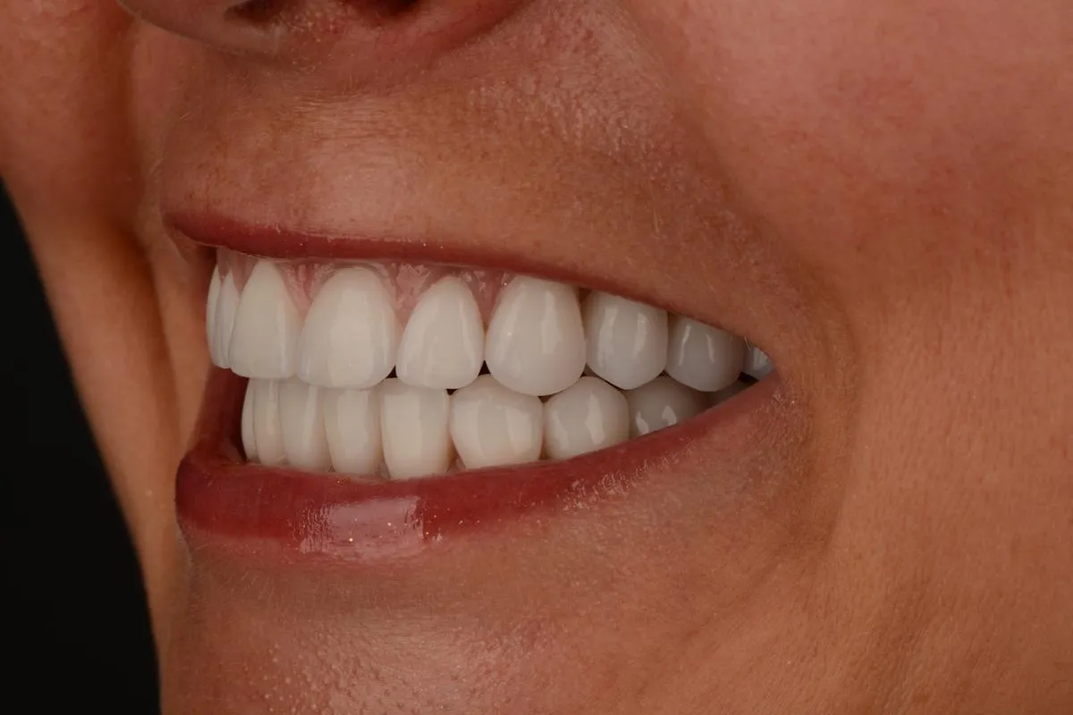 Zdjęcie Jak wybielić zęby u dentysty - skuteczne metody i ich efekty