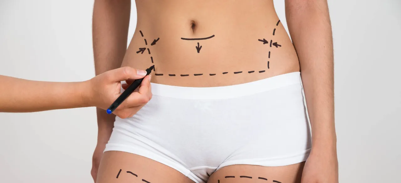 Zdjęcie Ile kosztuje liposukcja w Polsce? Sprawdź ceny i czynniki [2024]