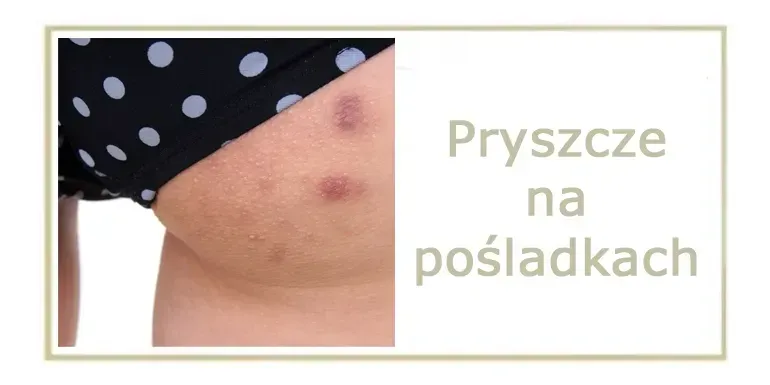 Zdjęcie Pryszcze na pośladkach: przyczyny, skuteczne leczenie i pielęgnacja