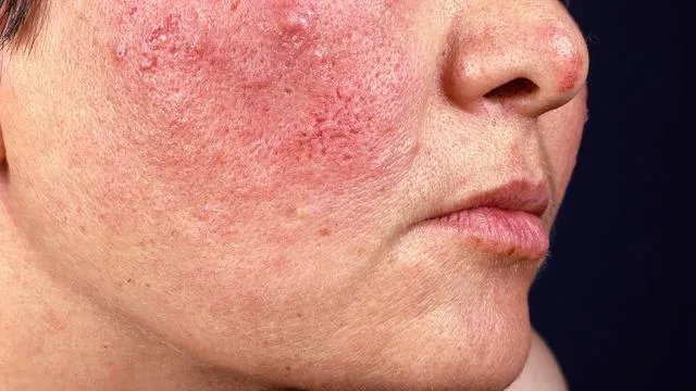 Zdjęcie Ursachen für brennende Gesichtshaut: Symptome und wirksame Lösungen