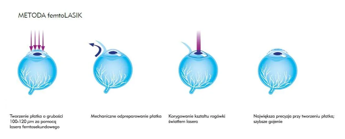 Zdjęcie Laserowa korekcja wzroku: która metoda jest najlepsza i dlaczego warto porównać?
