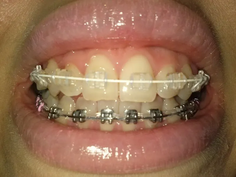 Zdjęcie Ile zakłada się aparat na zęby? Poznaj czas i przebieg wizyty