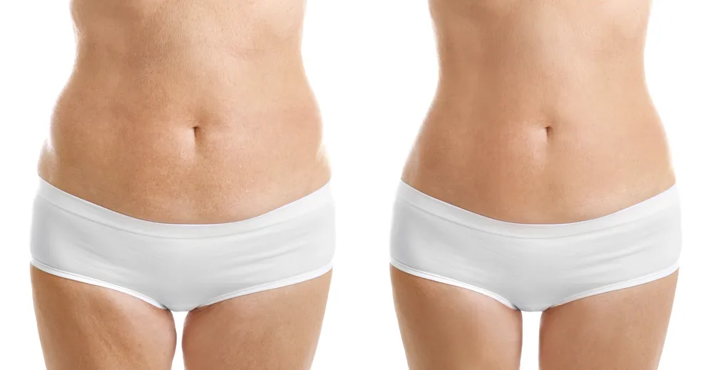 Zdjęcie Co lepsze: lipolaser czy liposukcja kawitacyjna? Porównanie skuteczności