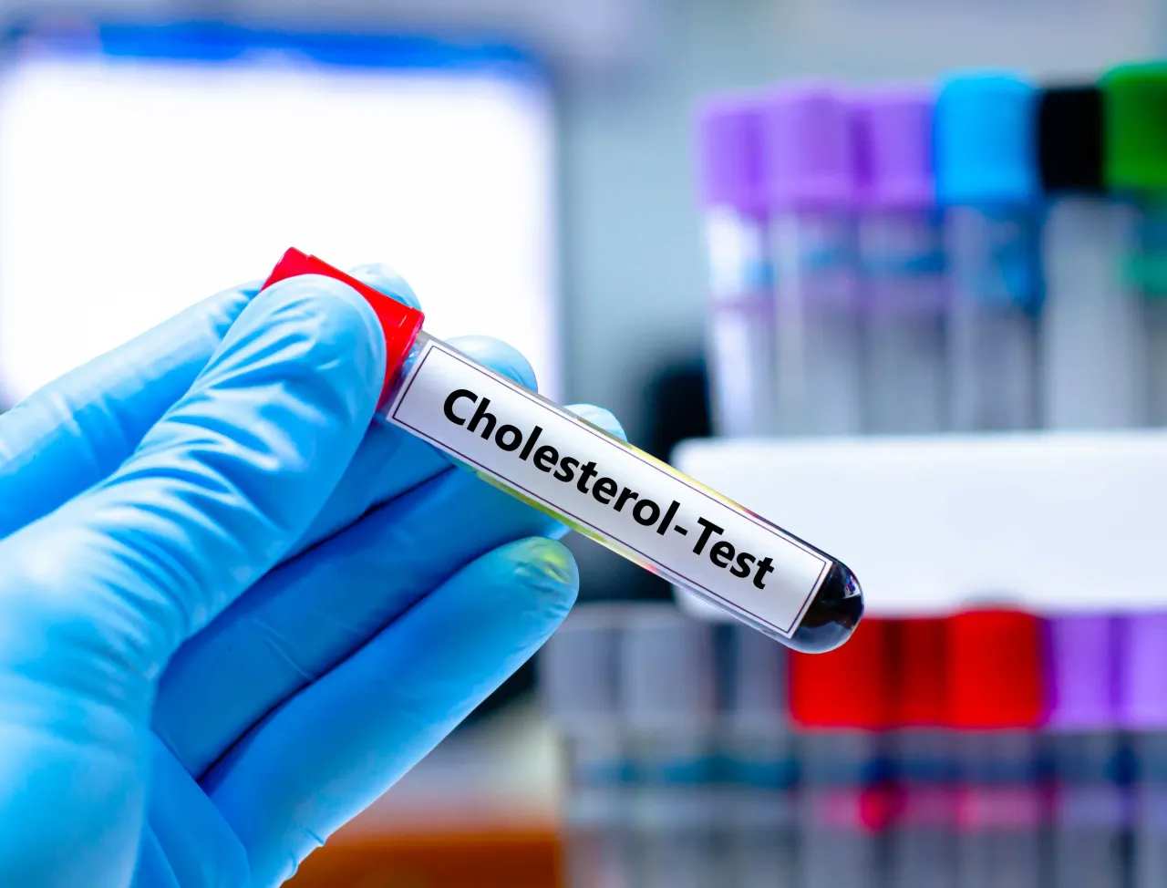 Zdjęcie Podwyższony poziom cholesterolu całkowitego – przyczyny, skutki i jak go obniżyć