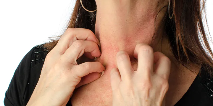 Zdjęcie Objawy tocznia rumieniowatego: poznaj pierwsze niepokojące symptomy choroby