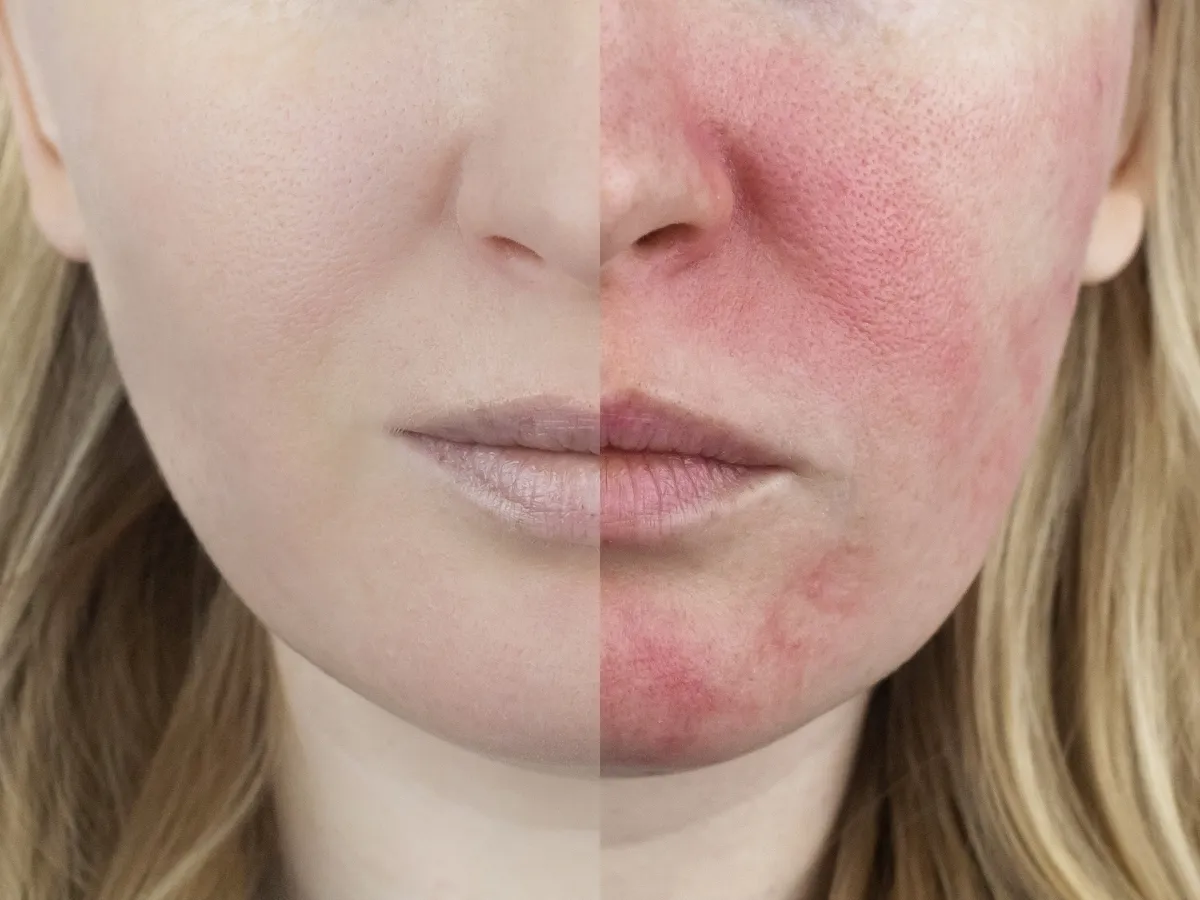 Zdjęcie Unreine Gesichtshaut bei Frauen: Ursachen, Symptome und Lösungen