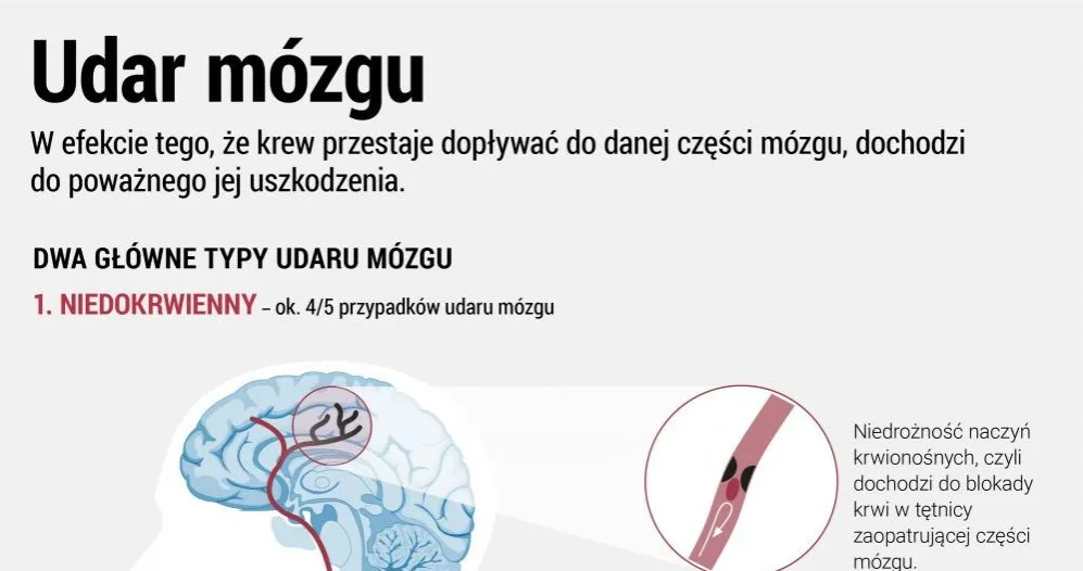 Zdjęcie Wylew objawy – jak je rozpoznać i co robić w nagłej sytuacji