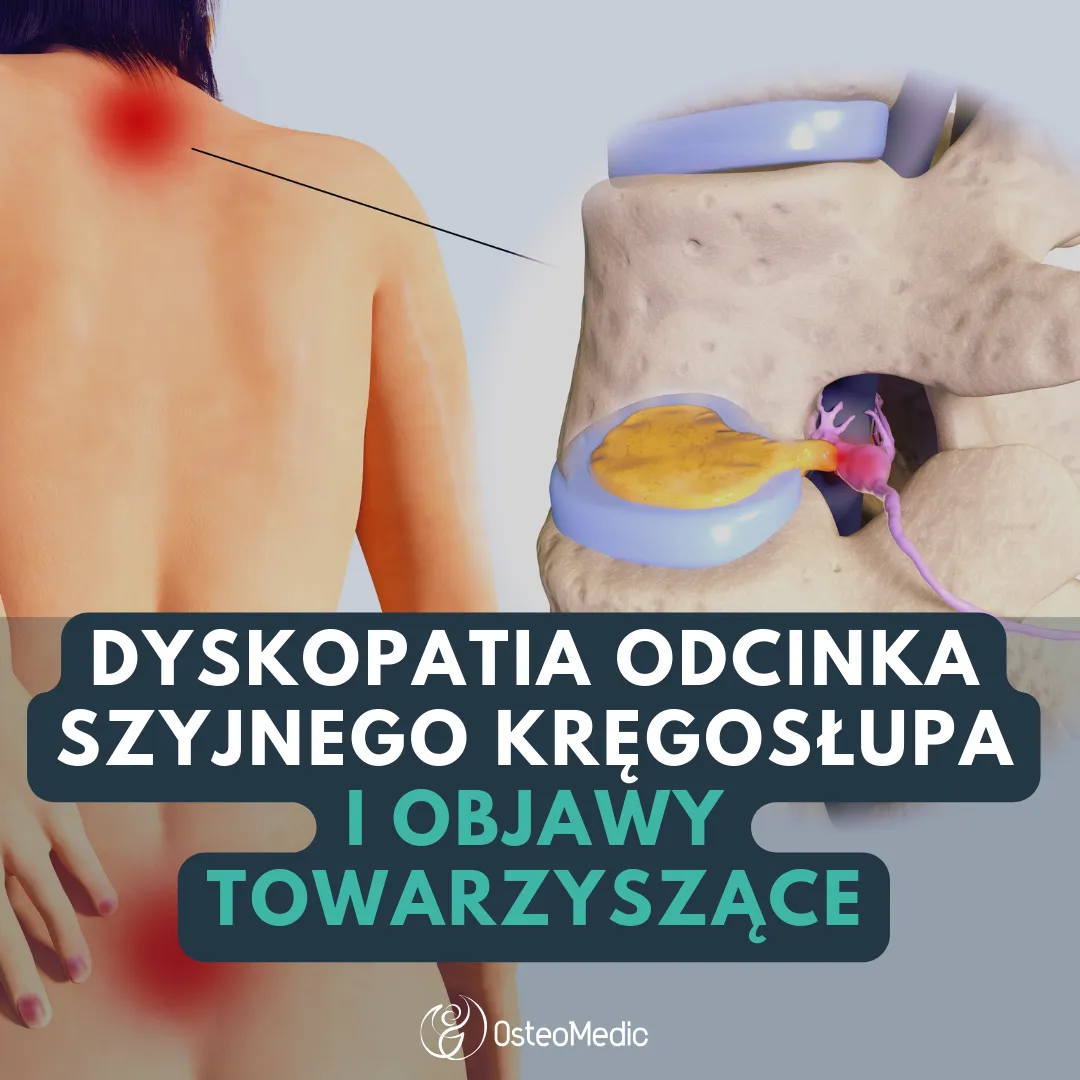 Zdjęcie Skręcenie kręgosłupa szyjnego: poważne objawy neurologiczne, które musisz znać