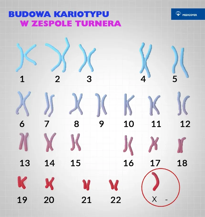 Zdjęcie Zespół Turnera objawy – poznaj niepokojące symptomy tej choroby
