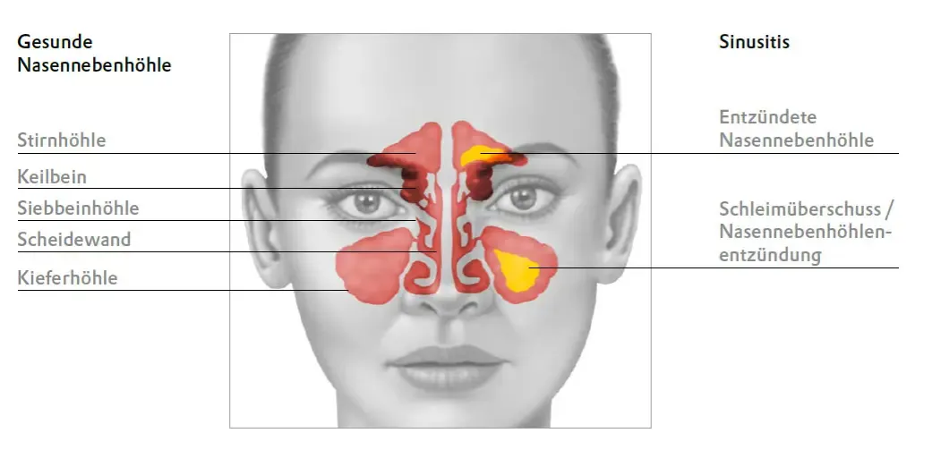 Zdjęcie Die häufigsten Symptome einer Nasennebenhöhlenentzündung erkennen