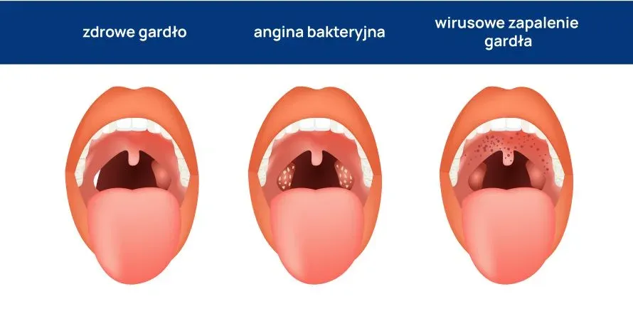 Zdjęcie Jakie są objawy anginy bakteryjnej i wirusowej? Charakterystyczne oznaki