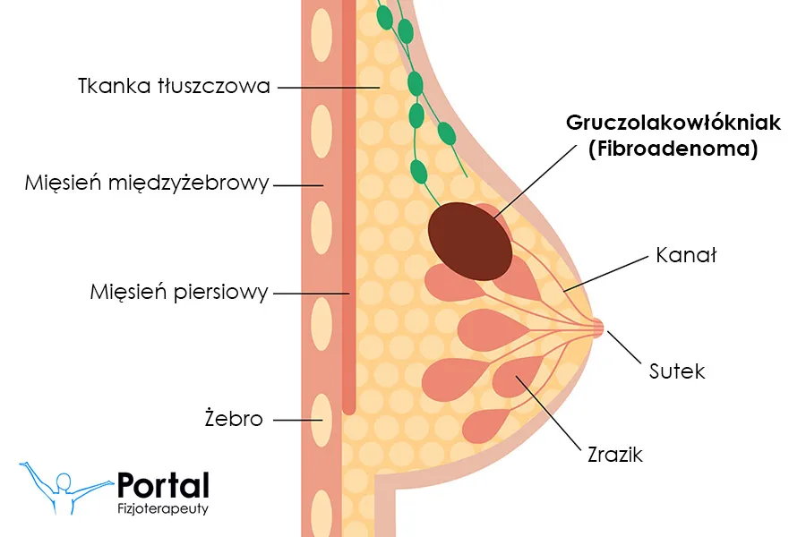 Zdjęcie Co oznacza symbol choroby N63: nieokreślony guzek w piersi - diagnoza