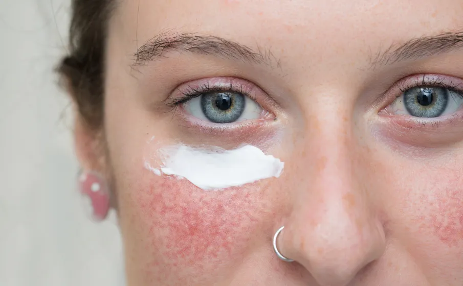 Zdjęcie Najlepszy peeling do cery naczynkowej - unikaj podrażnień i rumienia