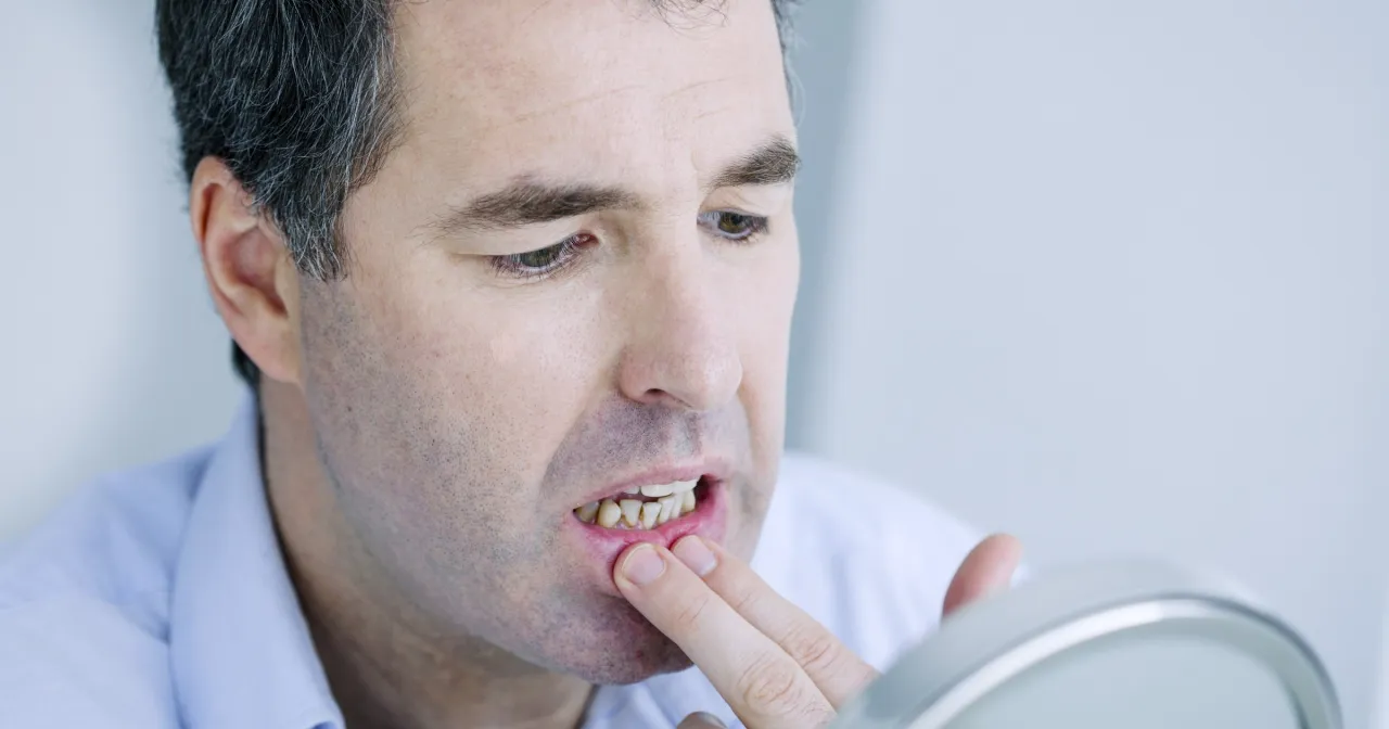 Zdjęcie Leczenie zapalenia dziąseł: leki OTC, recepta i domowe sposoby