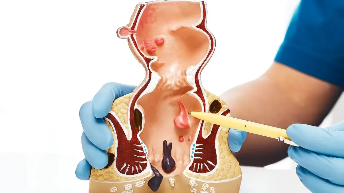 Zdjęcie Kłykciny kończyste: dermatolog czy urolog - który specjalista pomoże?