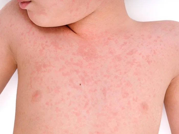 Zdjęcie Co na uczulenie po lekach? Skuteczne metody łagodzenia objawów