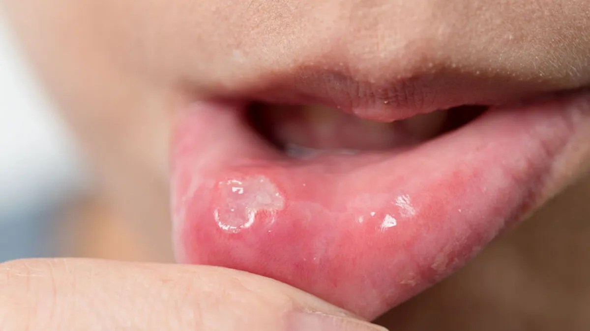 Zdjęcie Afty na dziąsłach: jak rozpoznać, leczyć i szybko znaleźć ulgę