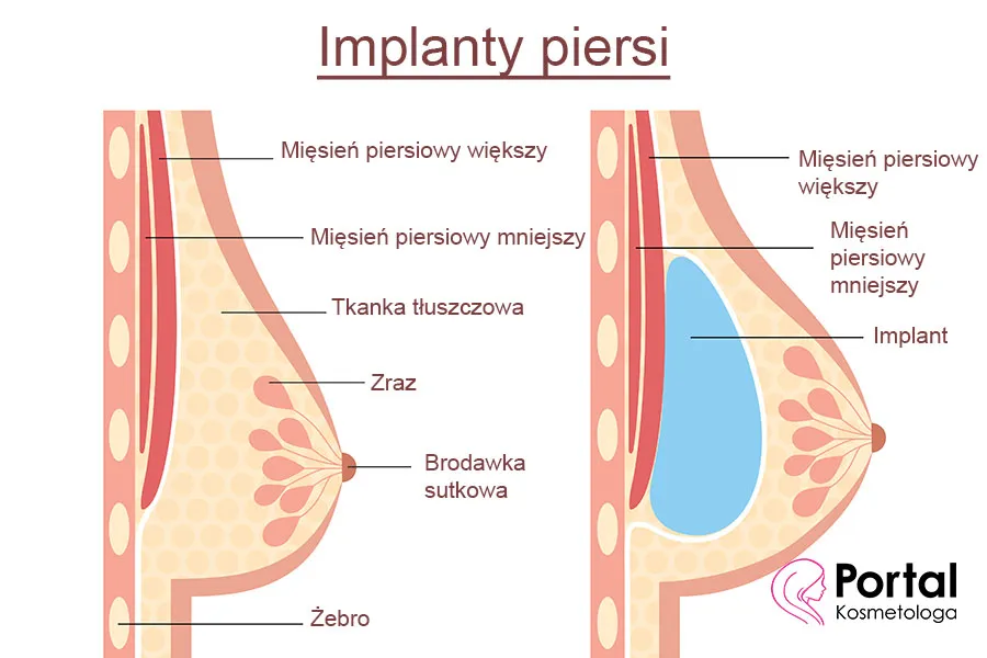 Zdjęcie Co ile trzeba wymieniać implanty biustu? Sprawdź, co musisz wiedzieć!