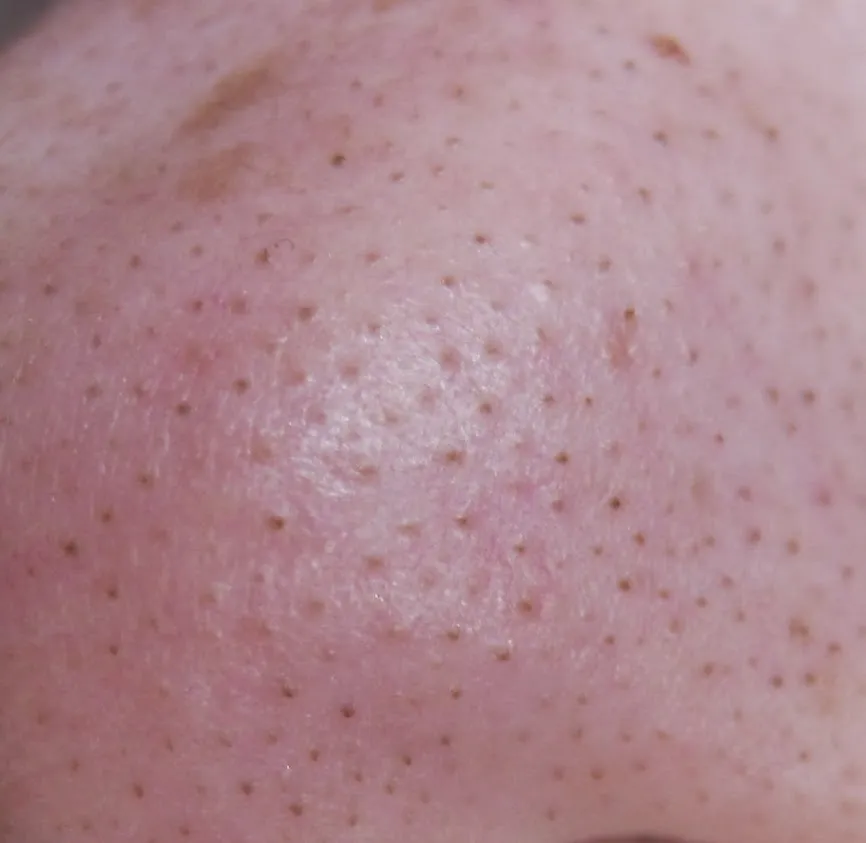 Zdjęcie Zapchana cera: Jak rozpoznać, co ją powoduje i jak ją leczyć?