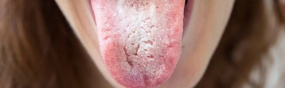 Zdjęcie Co na kandydozę jamy ustnej? Skuteczne metody leczenia i zapobiegania