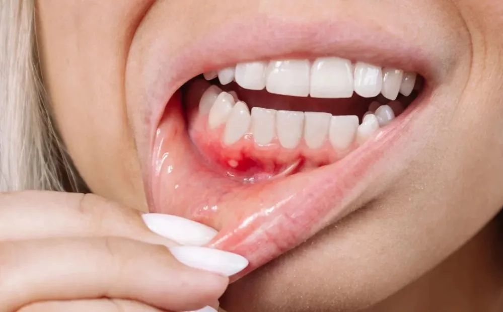 Zdjęcie Krwawiące dziąsła: Skuteczne sposoby i leczenie | Poznaj przyczyny