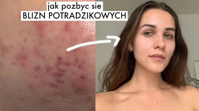 Zdjęcie Jak pozbyć się śladów po pryszczach – skuteczne metody i porady