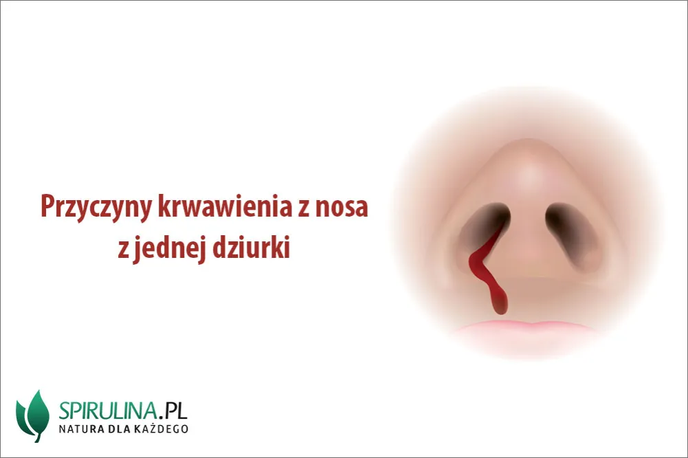 Zdjęcie Krwawienie z nosa przyczyny: najczęstsze powody i co z nimi zrobić.