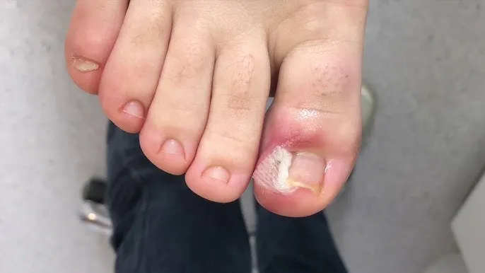 Zdjęcie Czy zrywanie paznokcia boli? Poznaj prawdę o bólu i leczeniu