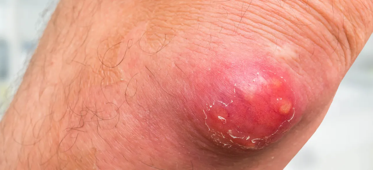 Zdjęcie Czyrak czy pryszcz? Kluczowe różnice, objawy i skuteczne leczenie