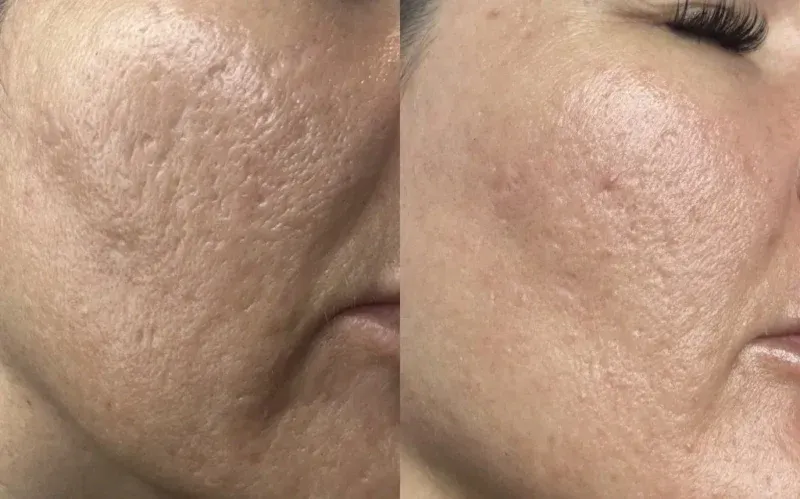 Zdjęcie Jak wygląda zabieg laser frakcyjny? Efekty i co warto wiedzieć